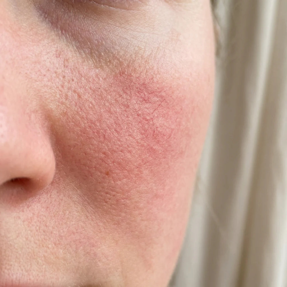 4. Your rosacea has 4 causes. Not one.