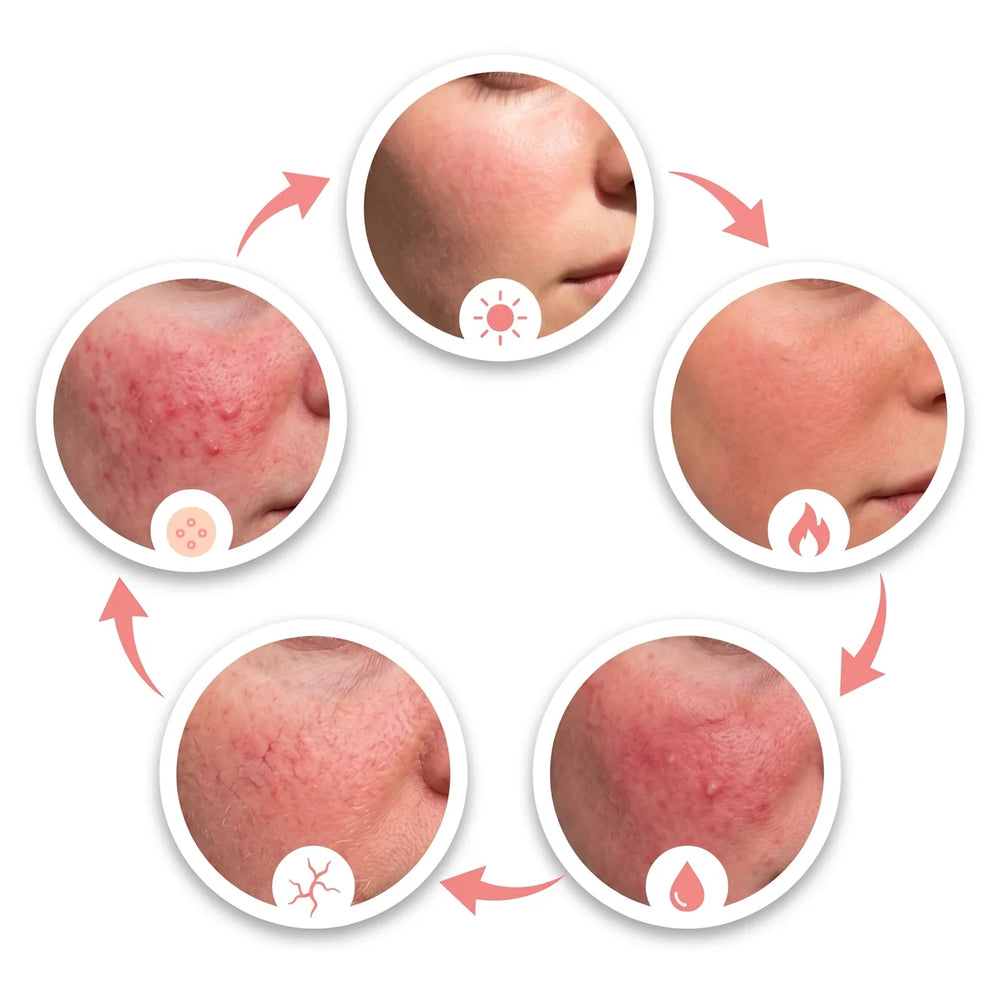 1. Your rosacea isn't your fate. It's a cycle.